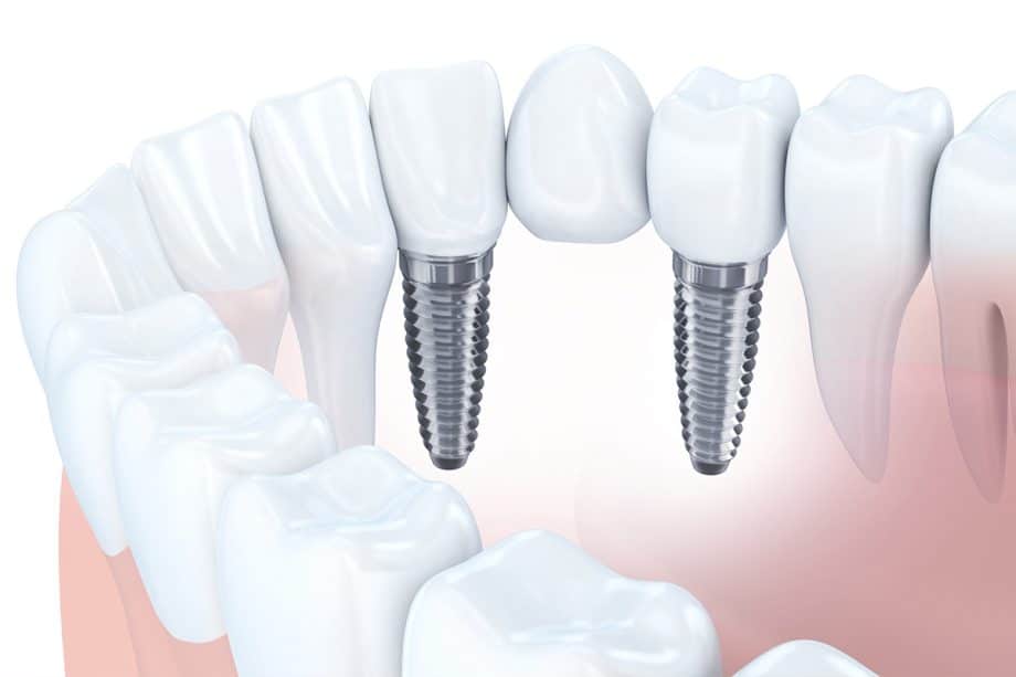 How Long Does It Take To Get Used To A Dental Bridge