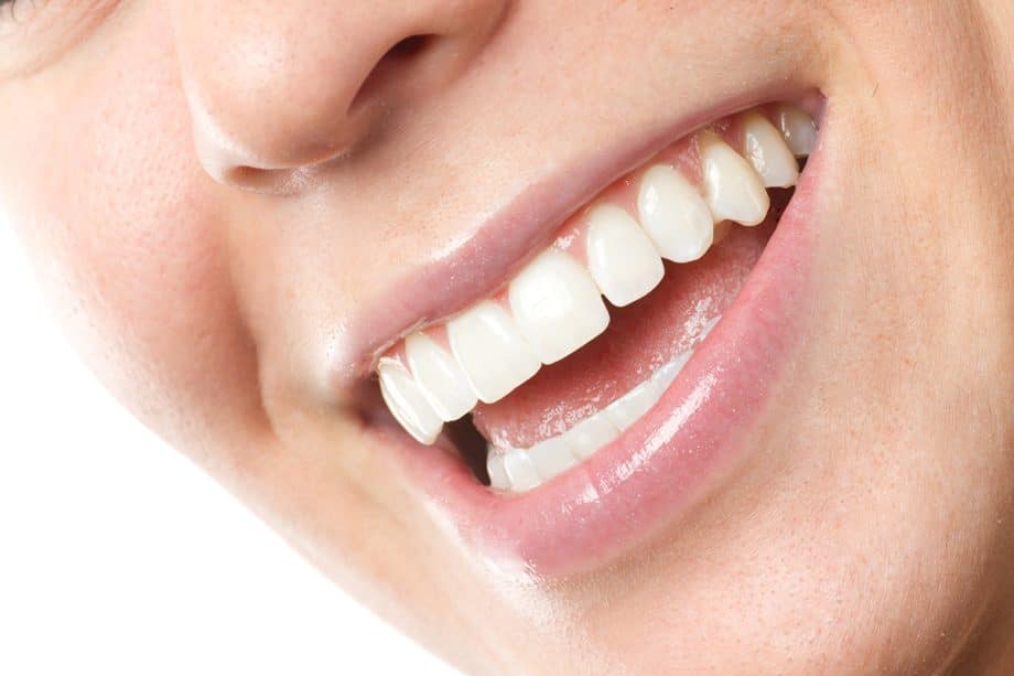 Are Dental Veneers Permanent?