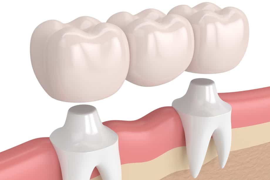 Can A Dental Bridge Be Removed And Recemented?