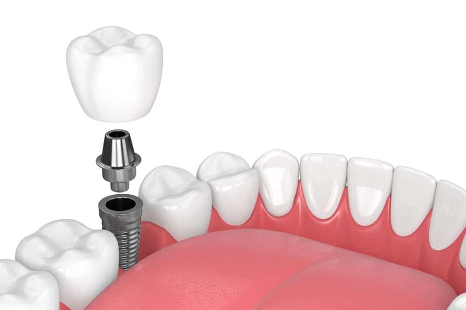 Can Dental Implants Be Done In One Day?