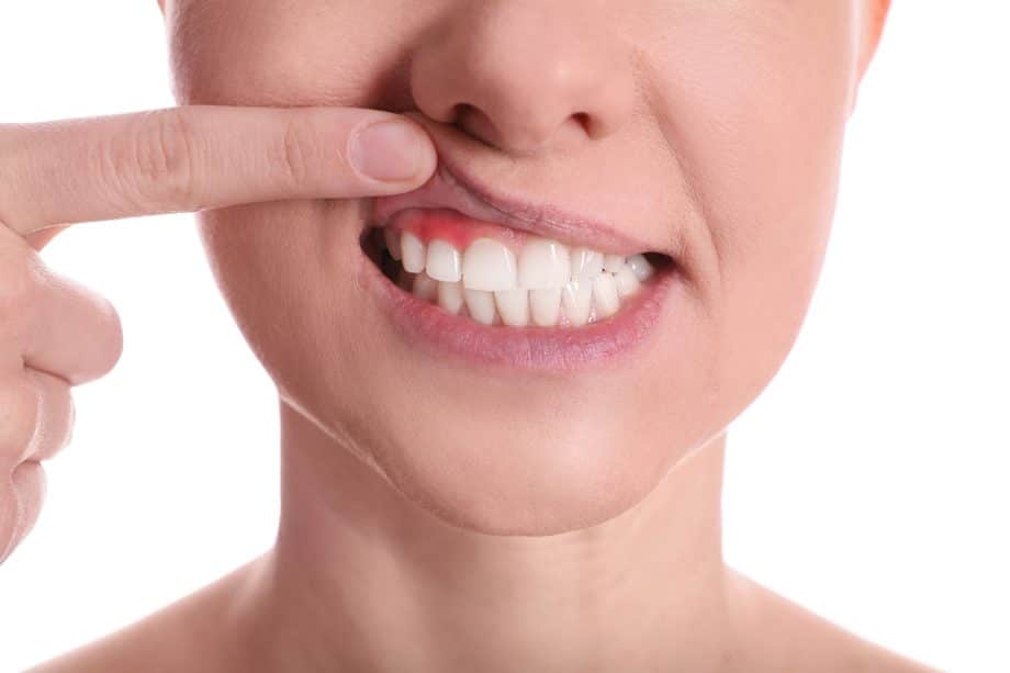 Early Signs of Gum Disease You Should Never Ignore