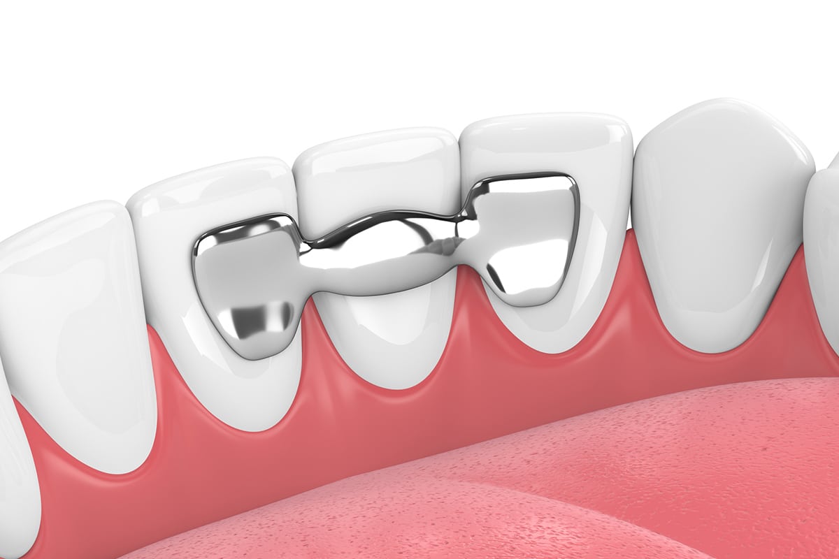 How long do dental bridges last blog.jpg