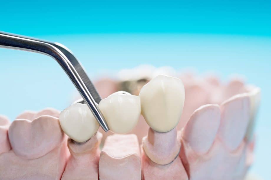 How Long Does It Take For a Dental Bridge To Settle?