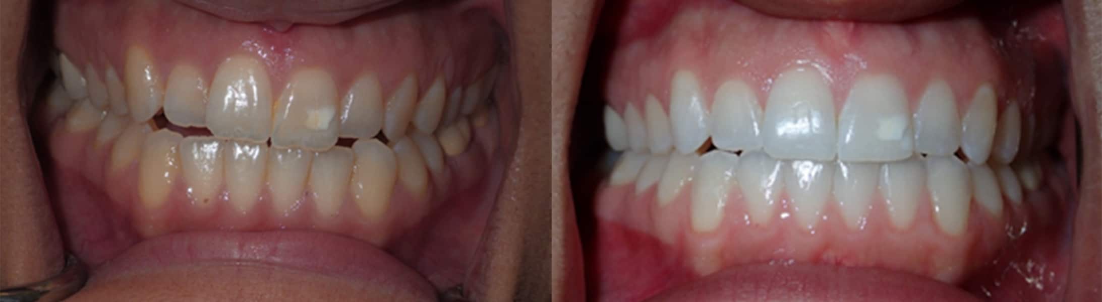 How Much Do Dentures Cost in Stuart, FL?