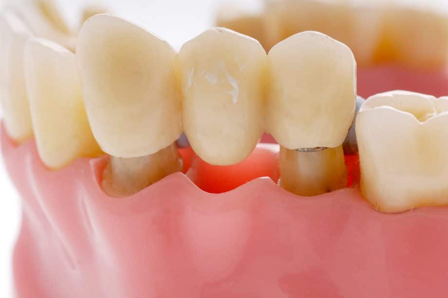 How Much Does A Dental Bridge Cost in Stuart, FL?