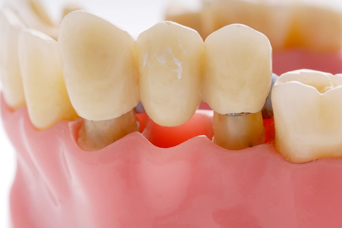 How much does a dental bridge cost in stuart fl blog.jpg