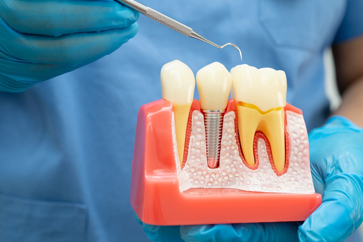 Implant supported crowns vs traditional bridges blog