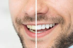 man-smiling-with-teeth-whitening-image-300x200.jpg