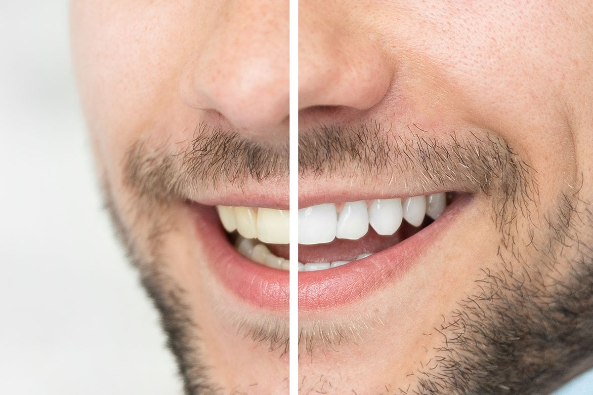 Man smiling with teeth whitening image