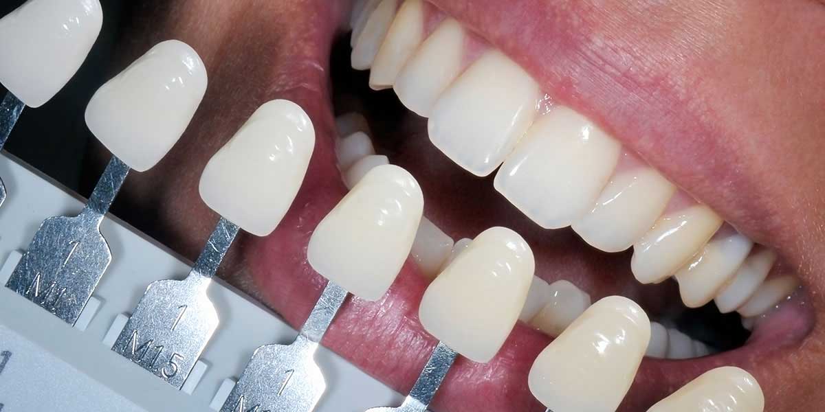 Dental Fillings & Bonding | Stuart Prosthetic Dentistry
