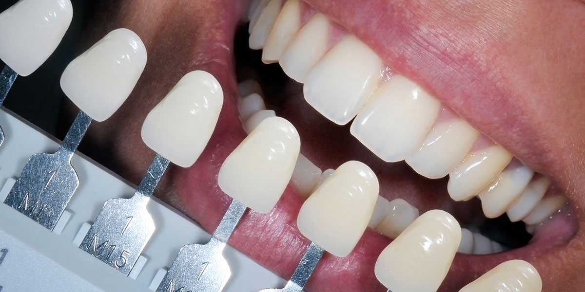 What Is Dental Bonding and What Are the Types?