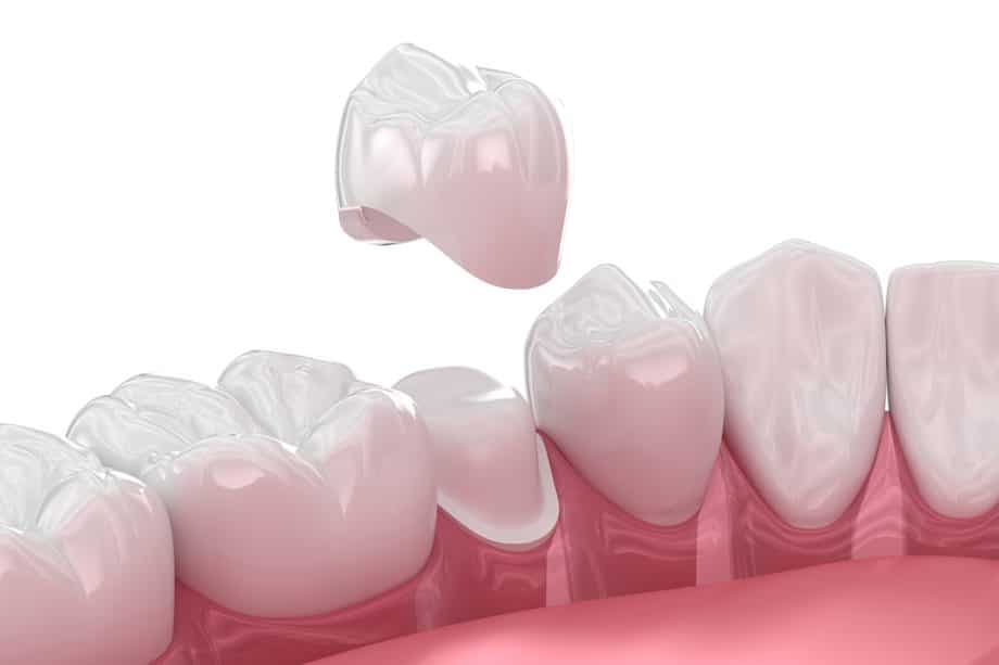 Top Signs Your Dental Crown Needs to Be Replaced