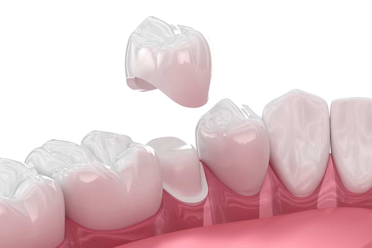 Top signs your dental crown needs to be replaced blog