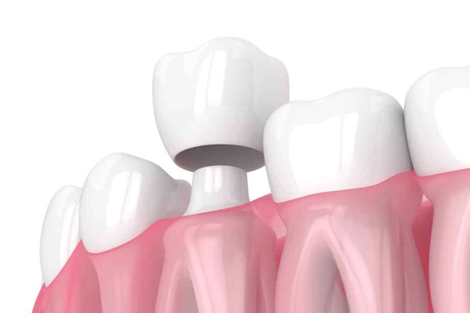 What Is Crown Lengthening and When Is It Recommended?