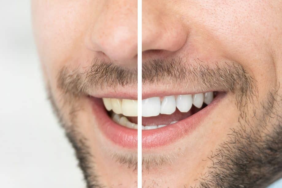 What Is The Best Way To Whiten Your Teeth?